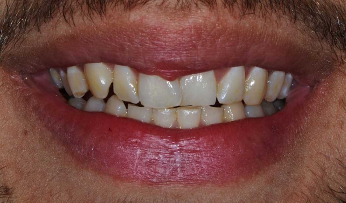 maladie parodontale dentalam dentiste france